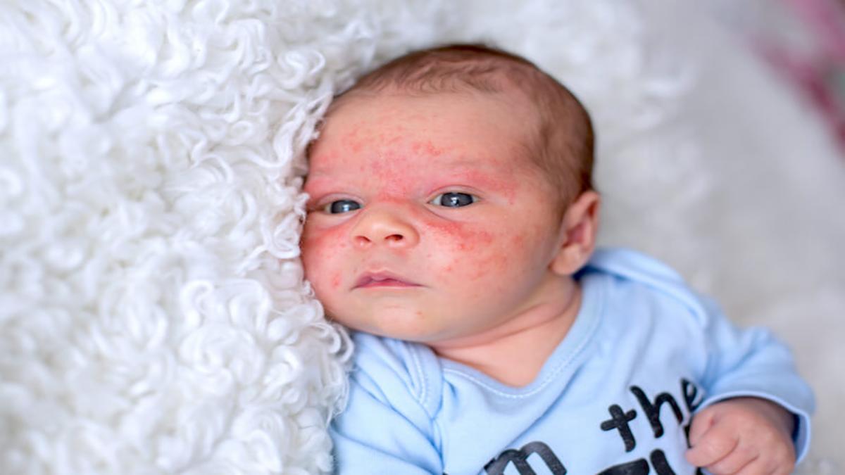Cow Milk Protein Allergy Market Valued at $1863.36M  by 2035